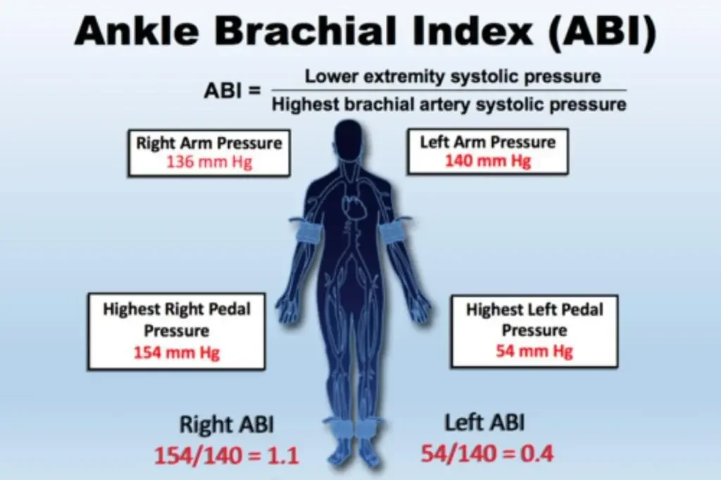 Ankle brachial index