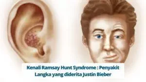 Kenali Ramsay Hunt Syndrome : Penyakit Langka yang diderita Justin Bieber