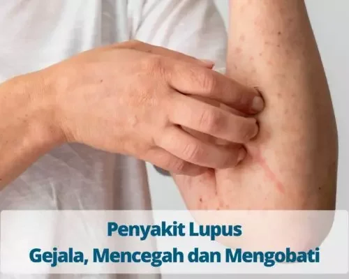 Penyakit Lupus Gejala, Mencegah dan Mengobati