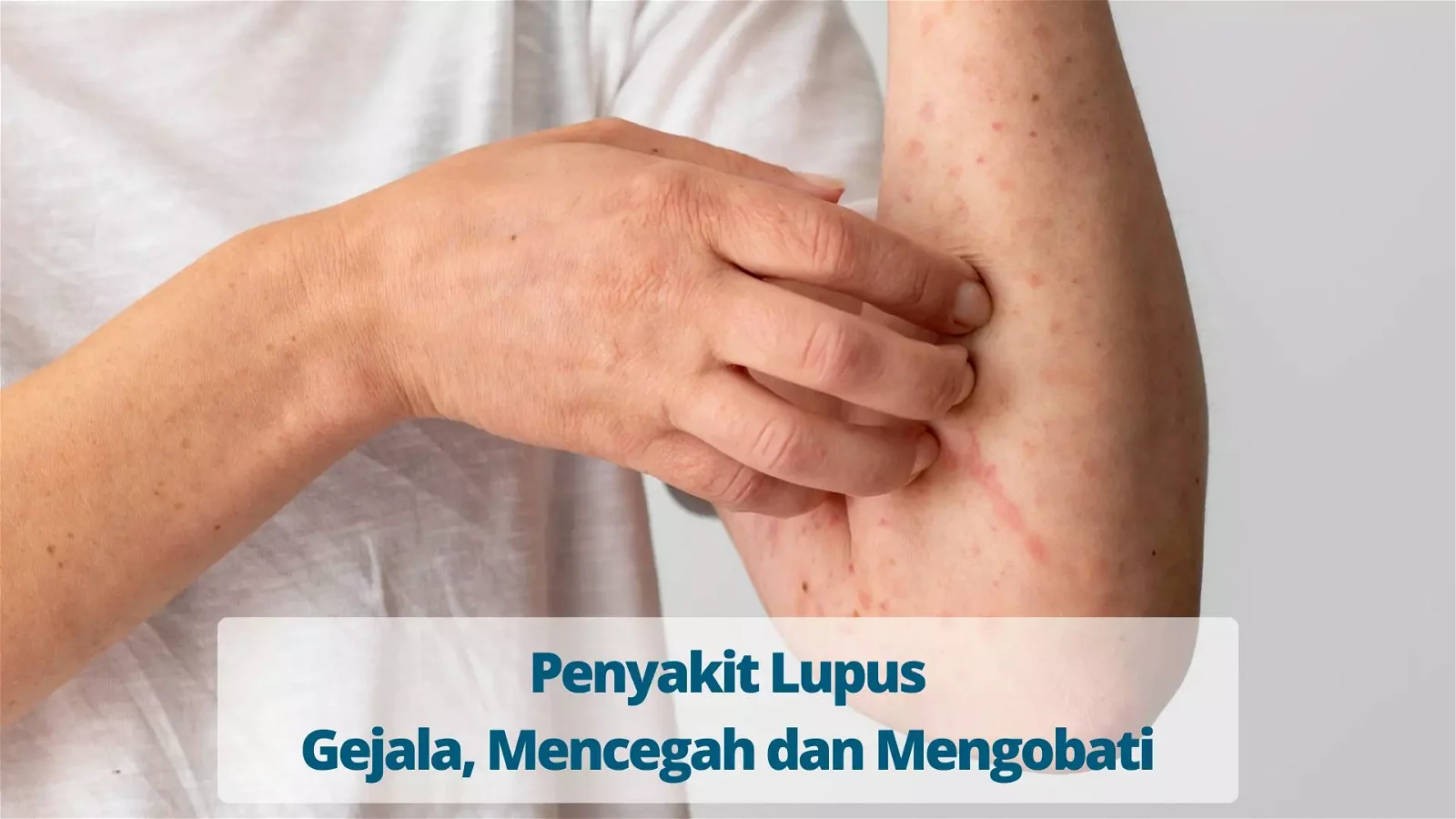 Penyakit Lupus Gejala, Mencegah dan Mengobati