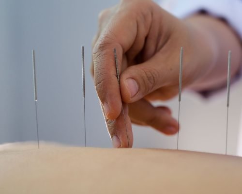 Akupunktur Medis, Pahami Manfaatnya Bagi Kesehatan Tubuh