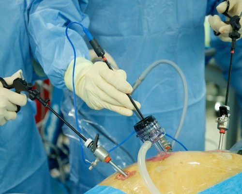 Laparotomy Cholecystectomy, Operasi Angkat Kandung Empedu