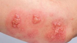 Kenali Herpes Zoster (Cacar Api/Dompo) dan Penanganannya